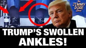 Here’s What Trump’s HUGE Swollen Ankles Mean! w/ Kim Bright