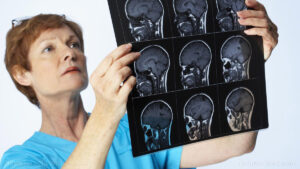 IBS, ulcers and diverticulitis linked to Alzheimer’s Disease – NaturalNews.com