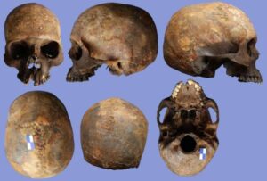 Extraordinary Care for Disabled Revealed in Roman Disaster Zone