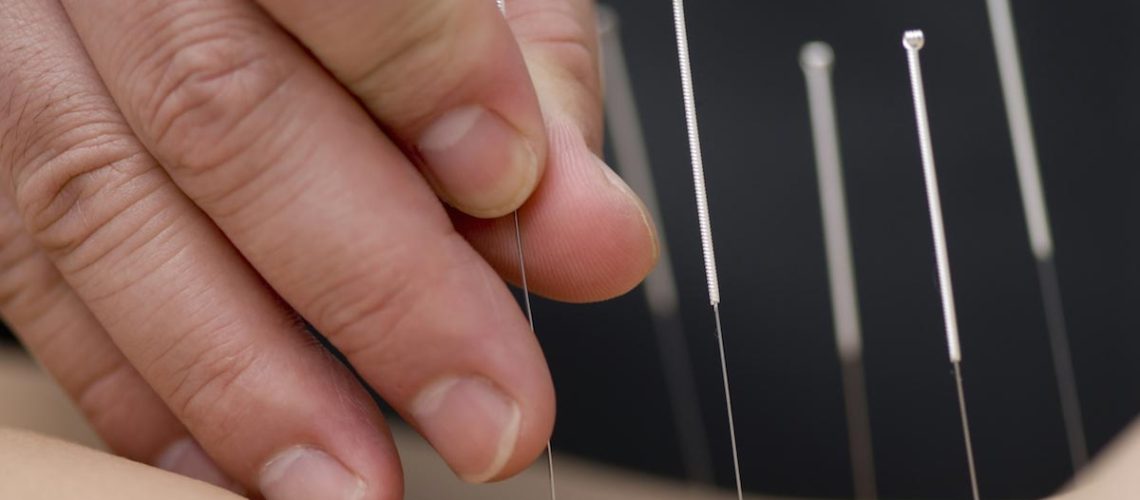 Acupuncture.jpg