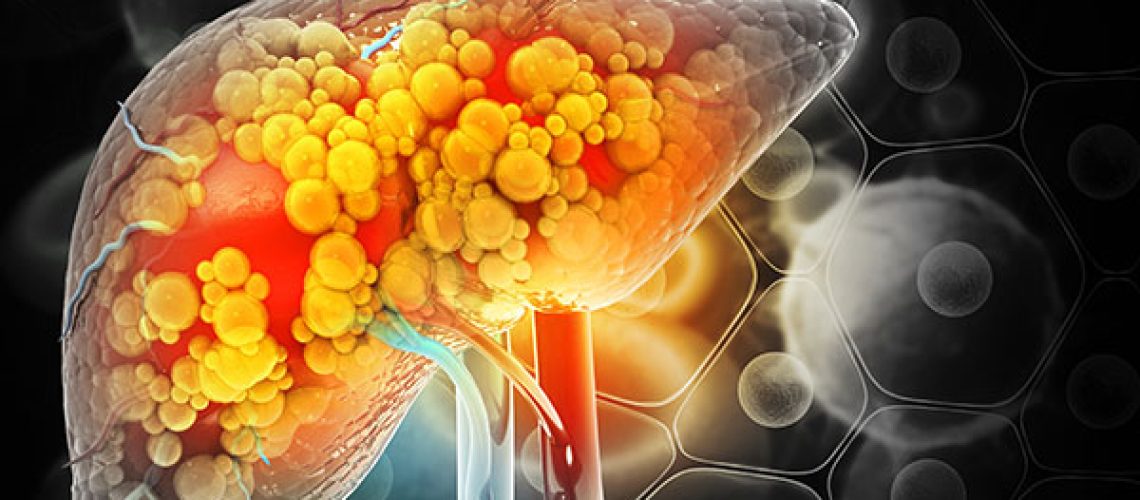 Liver-damage-such-as-Fatty-liver-1.jpeg Liver-damage-such-as-Fatty-liver-1.jpeg