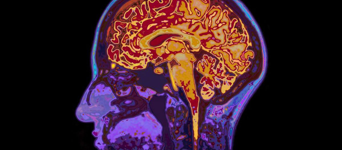 Mri-Image-Head-Showing-Brain.jpg