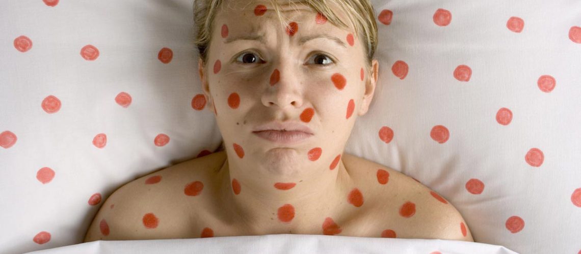 Patient-Sick-Measles-Chick-Pocks-Red-Marks-Spots.jpg