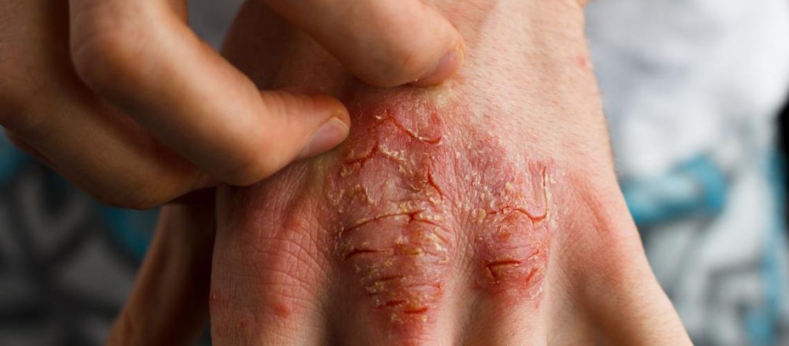 Psoriasis-Eczema-Treatment-Adult-Dermatology-Flaky-Itchy.jpg