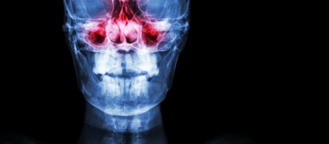 Sinus-Xray-Ent-Nose-Surgery-Nasal-Congestion.jpg