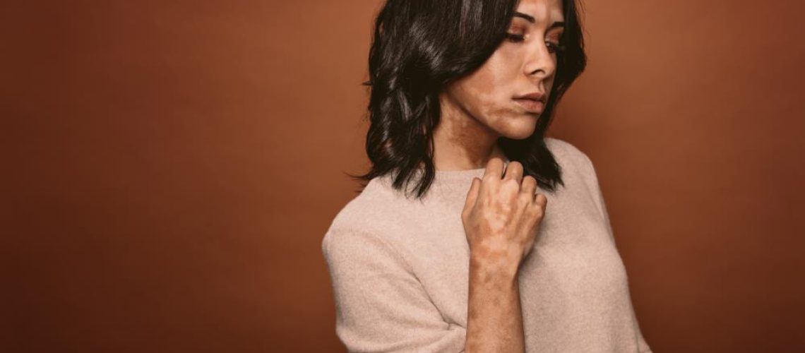Vitiligo-Skin-Affected-Background-Body-Brown-Bullied.jpg