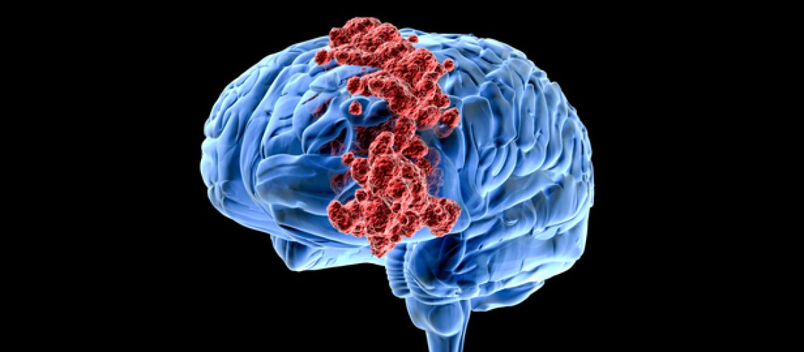 brain-cancer.jpg